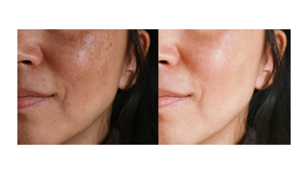 How To Get Rid Of Melasma Naturally