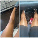 kojic acid soap before and after photos pictures knees