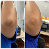kojic acid soap before and after photos pictures black skin elbows review