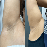 kojic acid soap before and after underarms pictures review