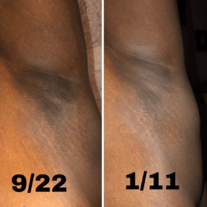kojic acid soap before and after underarms pictures review reddit