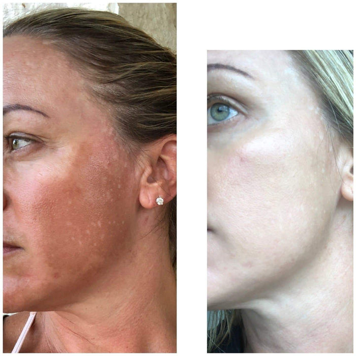 Natural Melasma Set - Marie France Skin & Body Care