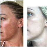 Melasma Soap