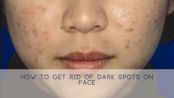 How to Get Rid of Dark Spots on Face?
