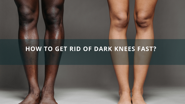 How To Get Rid Of Dark Knees Fast?
