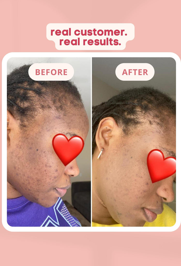 kojic acid soap before and after photos hyperpigmentation remover