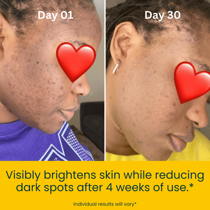 turmeric and kojic acid soap before and after photo 