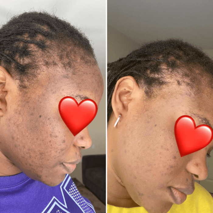 turmeric and kojic acid soap before and after photo 