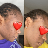 turmeric and kojic acid soap before and after photo 