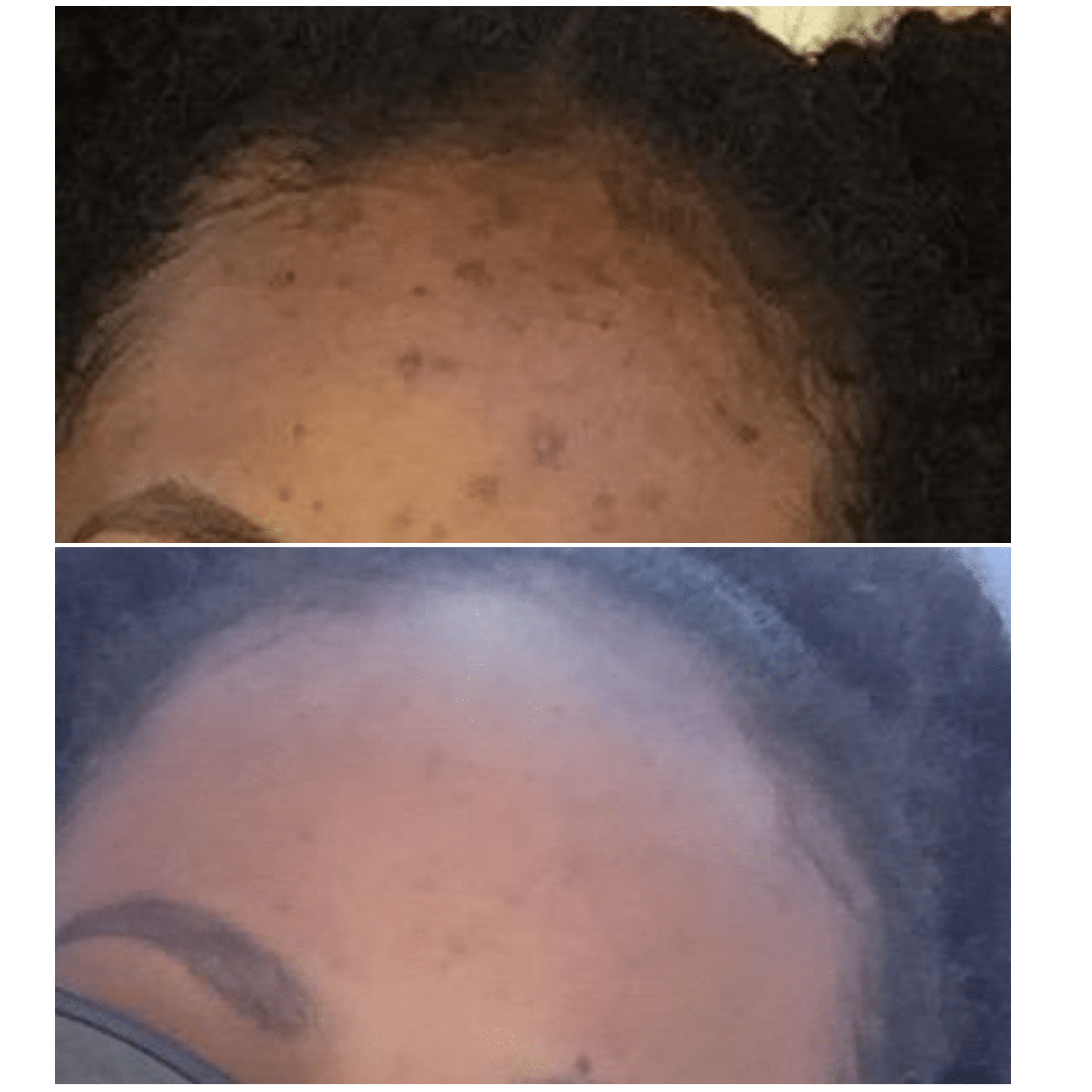 turmeric and kojic acid soap before and after photo 3