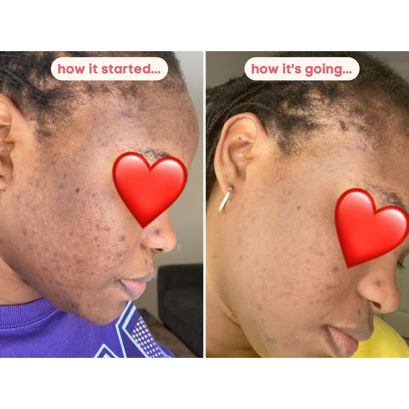 kojic acid skin lightening soap before and after photo