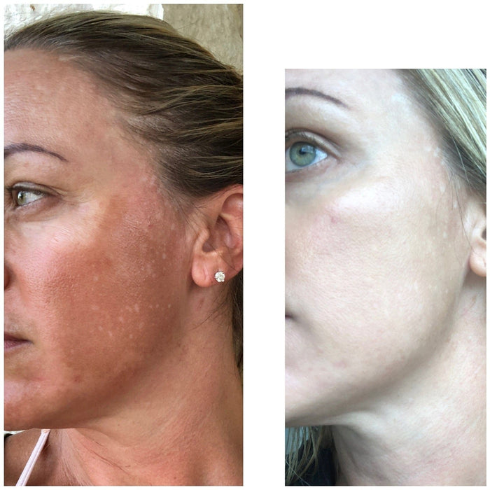 Natural Melasma Serum