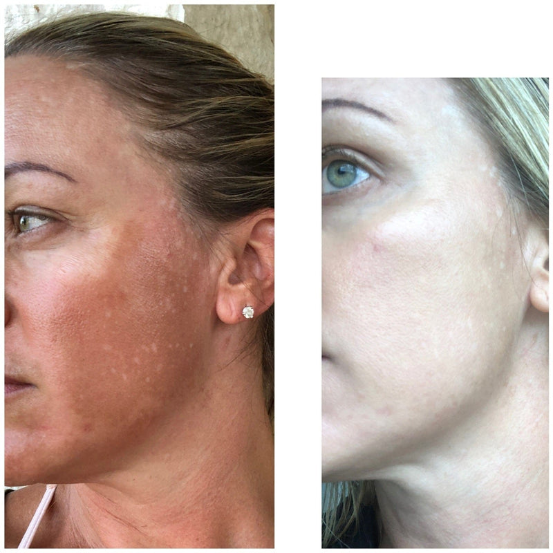 Kojic + Glycolic Acid Toner for Face